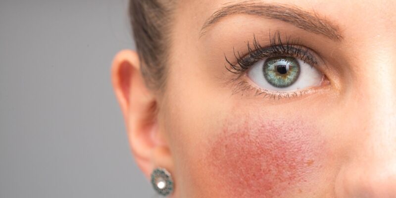 Symptômes de la rosacée sur la peau