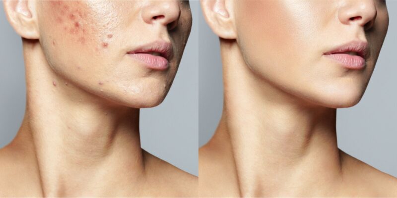 Traitement de l'acné avec BioAcne avant et après