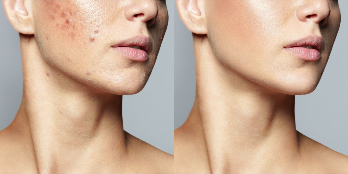 Traitement de l'acné avec BioAcne avant et après