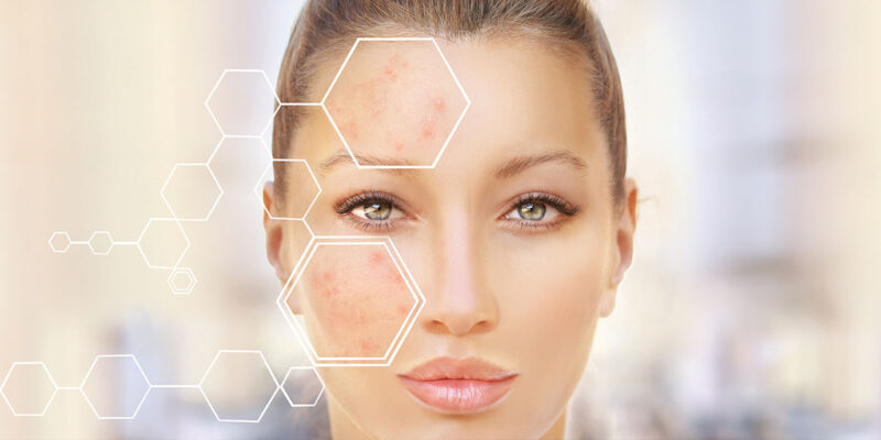 Why Certified-Organic Matters in Acne Treatments